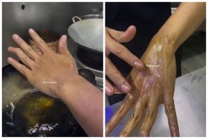 Jangan dioles pasta gigi, ini trik menangani kulit terkena minyak panas agar tak melepuh dan bengkak
