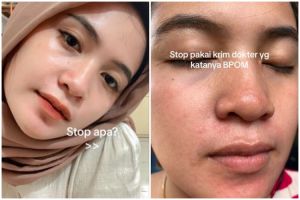 Niat cantik pakai krim dokter malah berakhir nyesek, wajah wanita ini jadi idap penyakit kulit