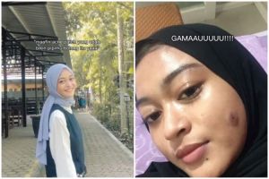 Kisah cewek pakai acne patch untuk atasi jerawat ini bukannya sembuh malah berujung pipi jadi bolong