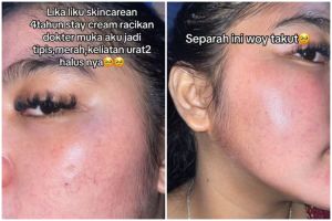 Kisah wanita lepas dari krim dokter ini penuh perjuangan, wajah tipis berurat jadi sehat kembali
