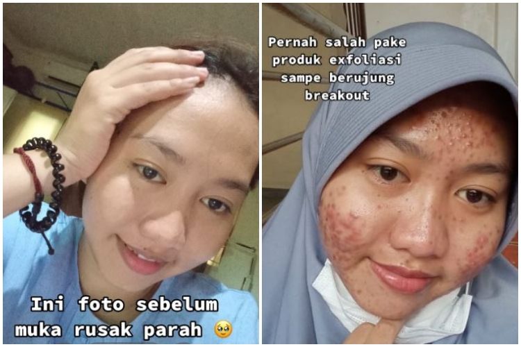 Wajah jadi rusak, cewek ini bagikan kisahnya alami breakout akibat salah pakai produk eksfoliasi