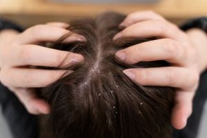 Baking soda dicampur 2 bahan dapur ini bisa atasi ketombe membandel, ini cara meracik dan memakainya