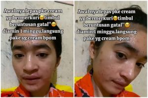 Kondisi wajahnya bikin nyesek, kisah cewek korban krim abal-abal ini buktikan bahayanya produk merkuri
