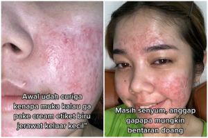Efek pakai krim etiket biru berujung bikin wajah rusak, kisah cewek ini bikin nyesek