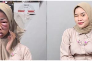 Viral potret cewek berwajah bengkak karena ketimpa barbel 1 kg, begini faktanya