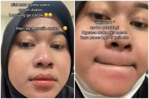 Niat pakai krim racikan dokter malah berujung menyesal, wajah cewek ini jadi bak kena air panas