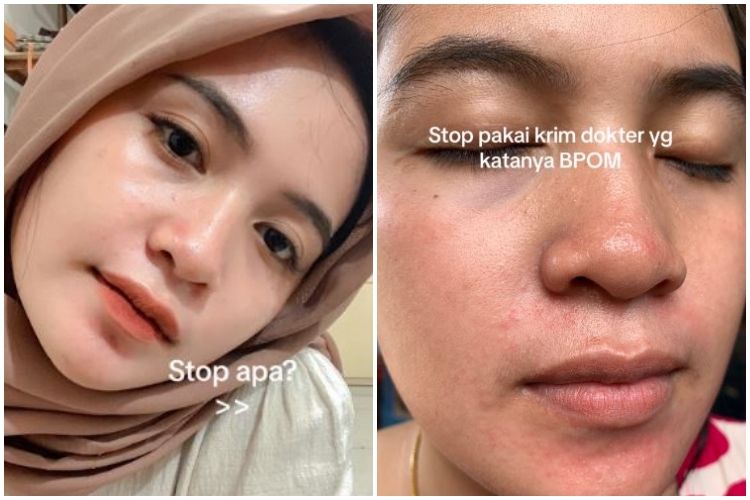 Efek pakai krim dokter malah berujung nyesek, wajah mulus cewek ini jadi terkena penyakit kulit