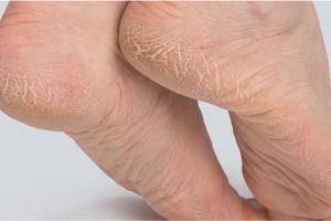 Cara atasi tumit kaki kering dan pecah-pecah agar mulus tanpa madu, cuma pakai 2 bahan alami