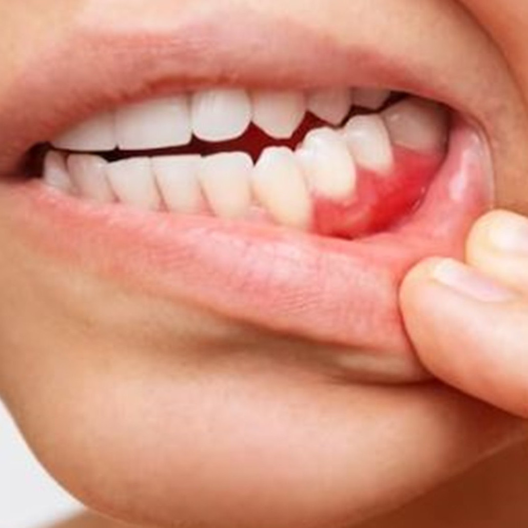 Cara ampuh hilangkan karang gigi agar tak makin parah hanya pakai 1 bahan rempah, gigi auto kinclong