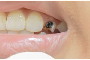 Trik hilangkan gigi hitam agar kembali putih tanpa baking soda, andalkan 1 jenis biji-bijian