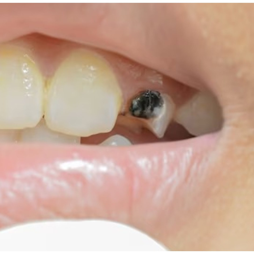 Trik hilangkan gigi hitam agar kembali putih tanpa baking soda ini andalkan 1 jenis biji-bijian