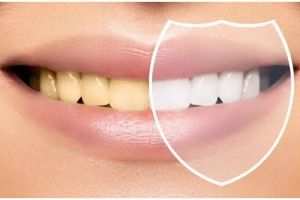 Trik hilangkan plak di gigi tanpa scaling di dokter, cuma andalkan 3 bahan alami