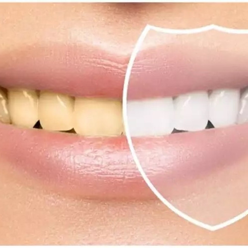 Trik hilangkan plak di gigi tanpa scaling di dokter, cuma andalkan 3 bahan alami