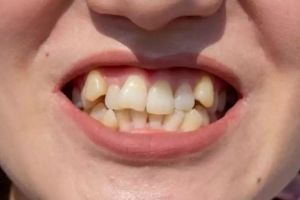 Cuma butuh waktu 2 menit, begini cara menghilangkan noda kuning pada gigi dengan 1 jenis bumbu dapur