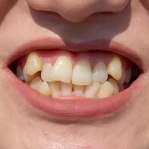 Cuma butuh waktu 2 menit, begini cara menghilangkan noda kuning pada gigi dengan 1 jenis bumbu dapur