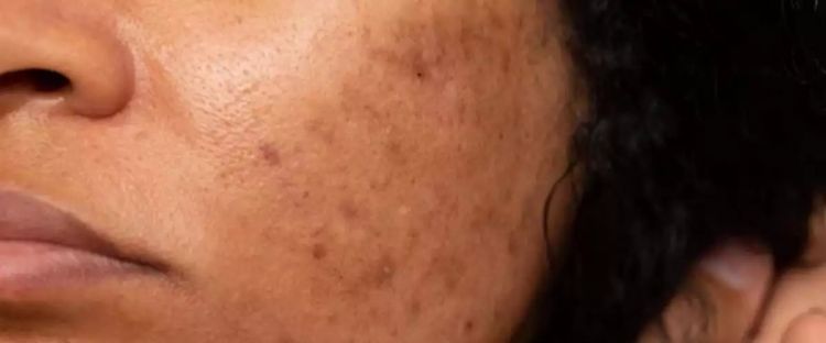 Trik hilangkan flek hitam membandel di wajah, hilang tak bersisa pakai 1 jenis bahan pemanis