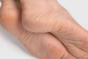 Cara kembalikan tumit retak jadi halus tanpa minyak zaitun, cukup pakai 1 jenis tepung