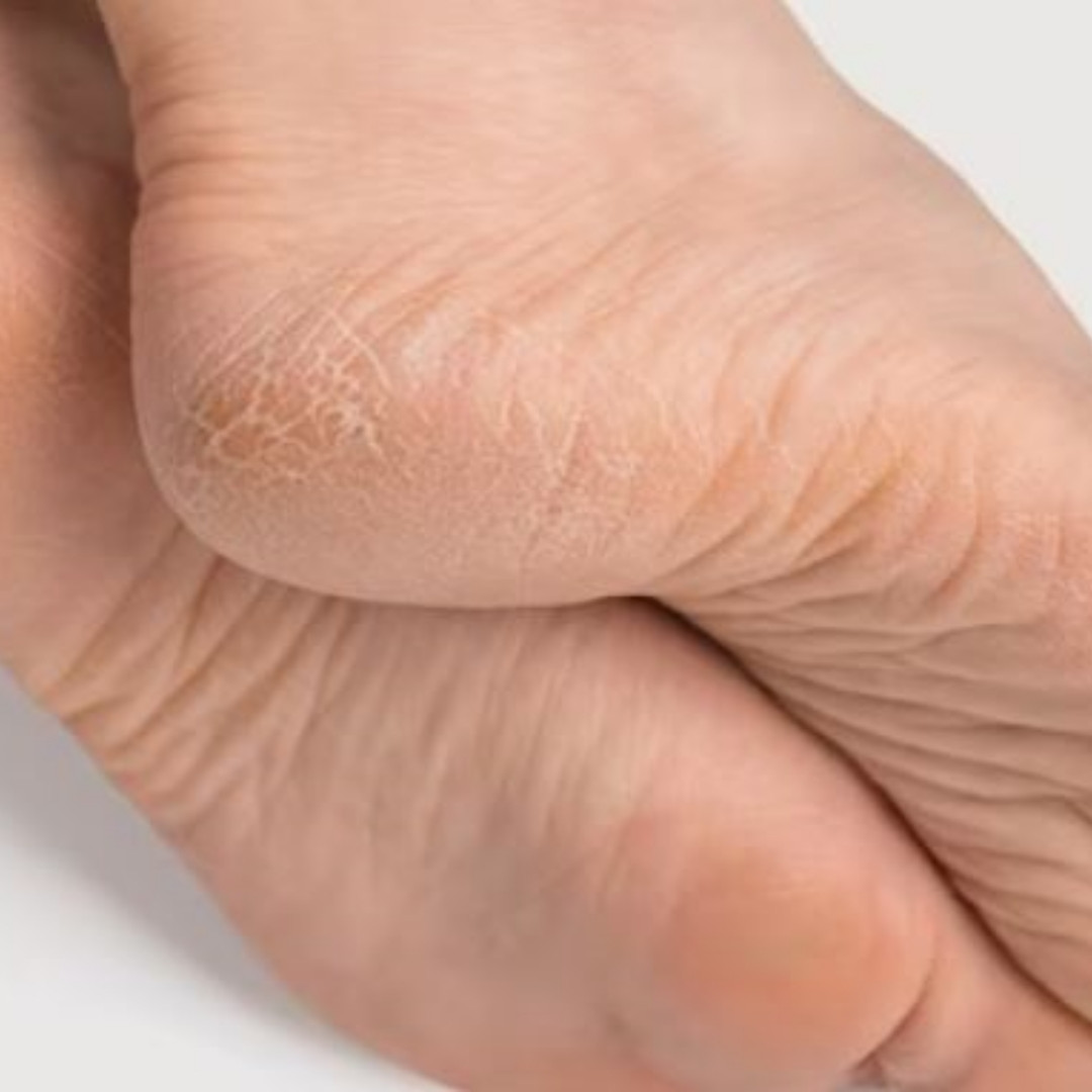 Cara kembalikan tumit retak jadi halus tanpa minyak zaitun, cukup pakai 1 jenis tepung