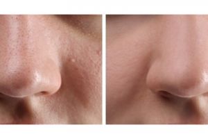 Trik hempas komedo dan pori-pori besar pakai 1 jenis minuman, ampuh langsung hilang dalam sehari 