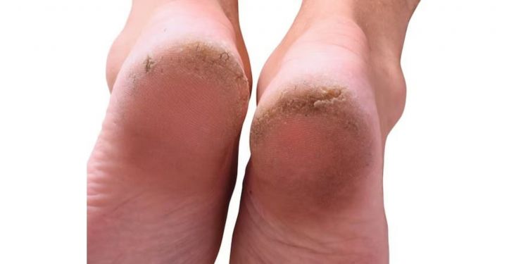 Cara bersihkan telapak kaki retak dan menghitam, mulus seketika cuma pakai 1 bahan pemanis