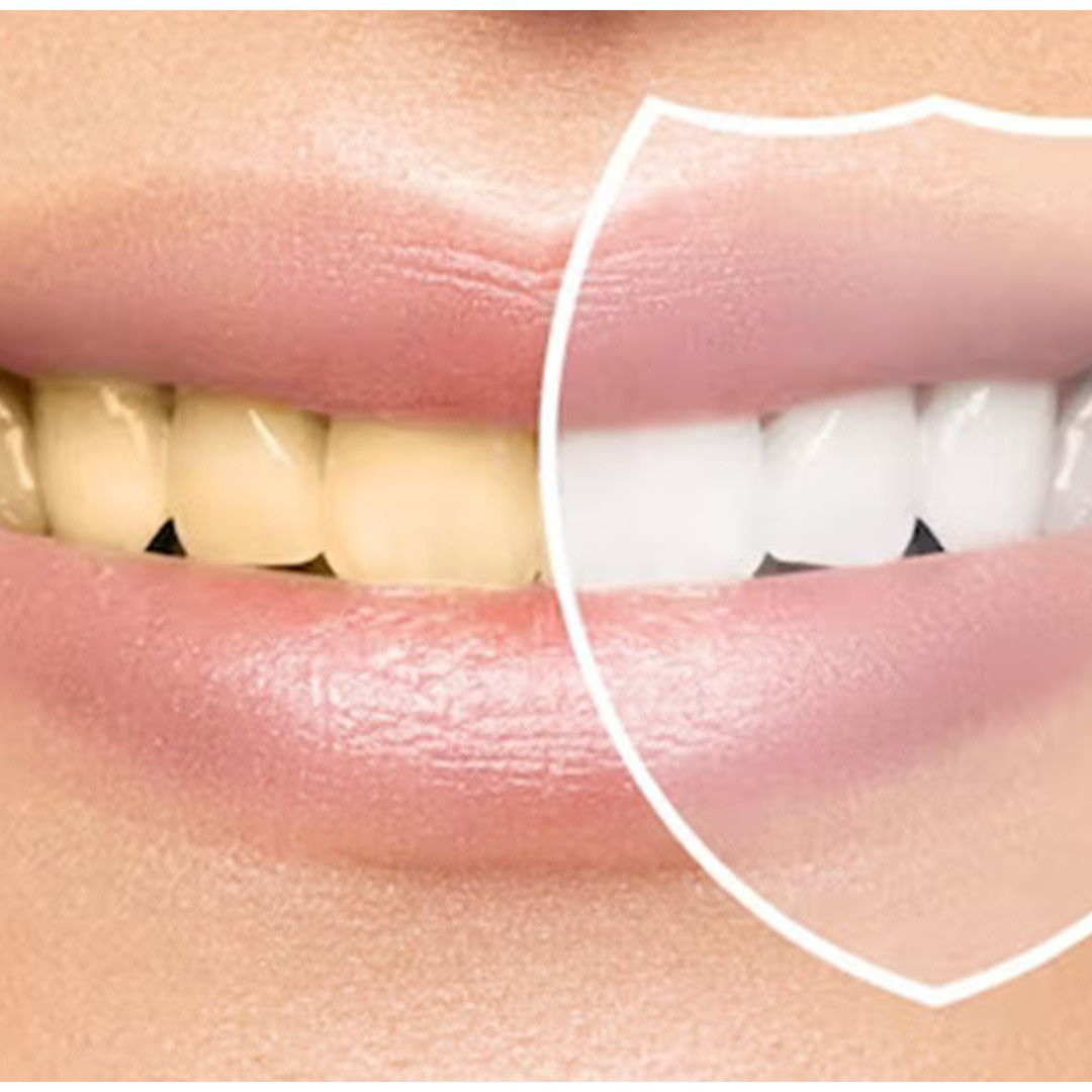 Trik pudarkan noda kuning di gigi tanpa kumur minyak kelapa, langsung putih andalkan 1 bahan dapur