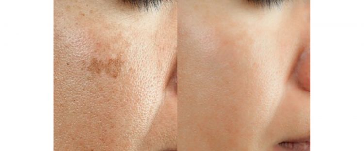 Trik hilangkan flek hitam pakai 2 jenis minuman, ampuh bikin wajah tampak lebih cerah