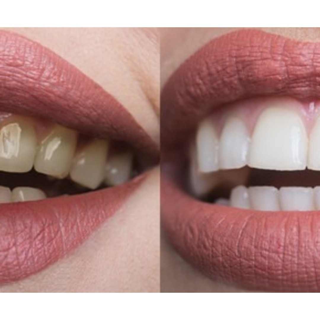 Trik hilangkan plak di gigi pakai 1 jenis bumbu dapur, auto putih cemerlang bak di-bleaching