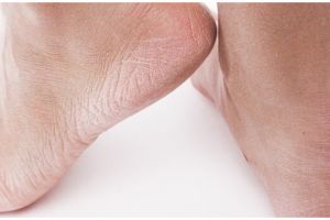 Cara melembutkan tumit kaki pecah-pecah dengan satu bahan dapur, tak perlu pakai pelembap
