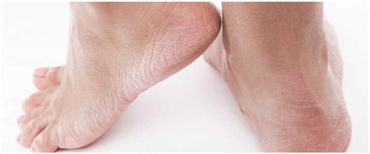 Cara melembutkan tumit kaki pecah-pecah dengan satu bahan dapur, tak perlu pakai pelembap