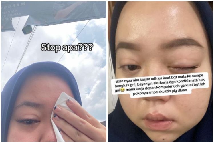 Wanita ini pasang eyelash extension sendiri malah bikin kornea mata luka, ternyata ini penyebabnya