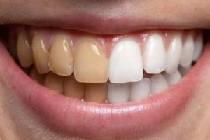 Cara putihkan gigi kuning penuh plak pakai 1 rempah dapur, hasil terlihat dalam 15 menit