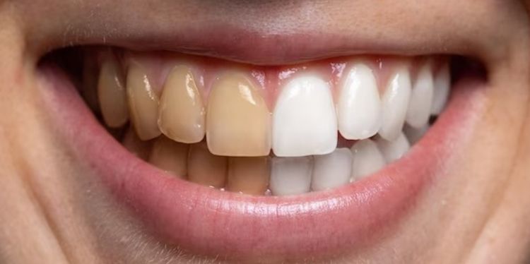Cara putihkan gigi kuning penuh plak pakai 1 rempah dapur, hasil terlihat dalam 15 menit
