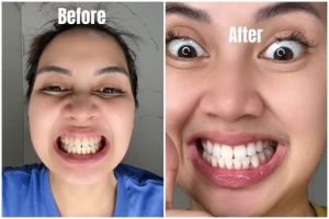 Review pasta gigi bubuk MeToo Teeth Probiotic diklaim mampu putihkan gigi kuning dalam sekali pakai