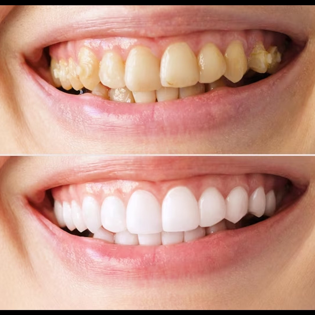 Cara hilangkan noda kuning membandel pada gigi tanpa scaling cuma andalkan 1 bahan minuman rempah