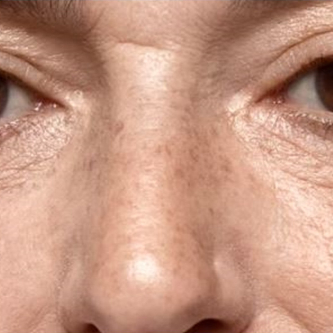 Trik menghilangkan flek hitam tanpa laser wajah, langsung cerah cuma andalkan 1 jenis buah