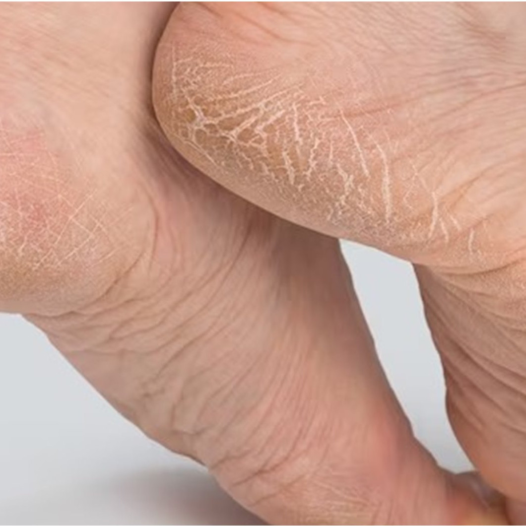 Cara atasi tumit kaki kering dan pecah-pecah tanpa scrub, langsung mulus pakai 2 bahan alami