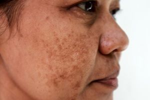 Trik meratakan warna kulit dari flek hitam, ampuh cuma andalkan 1 jenis minuman