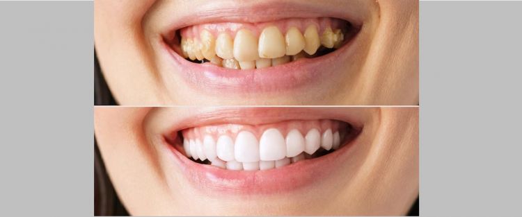 Trik memutihkan noda kuning pada gigi tanpa baking soda, ampuh cuma andalkan 1 bahan rempah