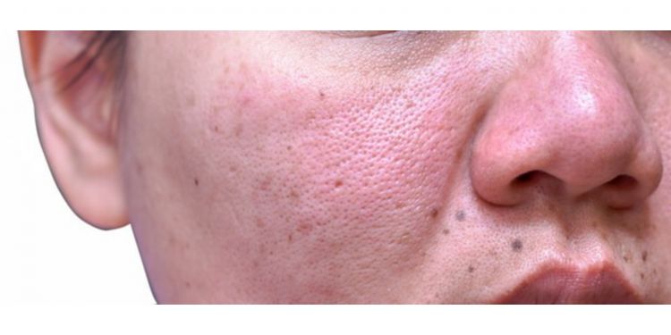 Cara kecilkan pori-pori tanpa beli porepack, ampuh bikin wajah bebas minyak pakai 1 bahan masak