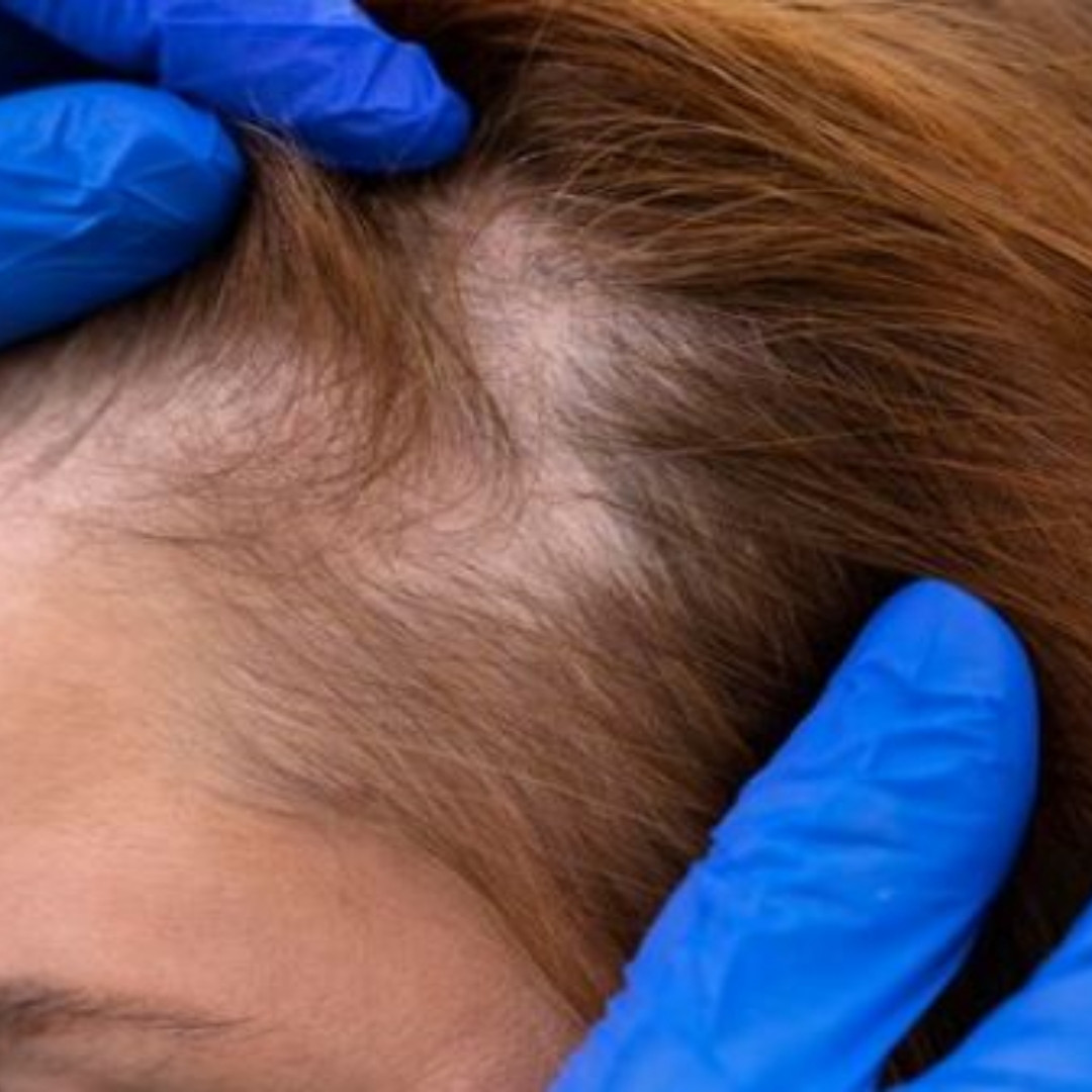 Cara tumbuhkan rambut tipis area tanpa minyak zaitun, ampuh pakai 1 jenis bumbu dapur