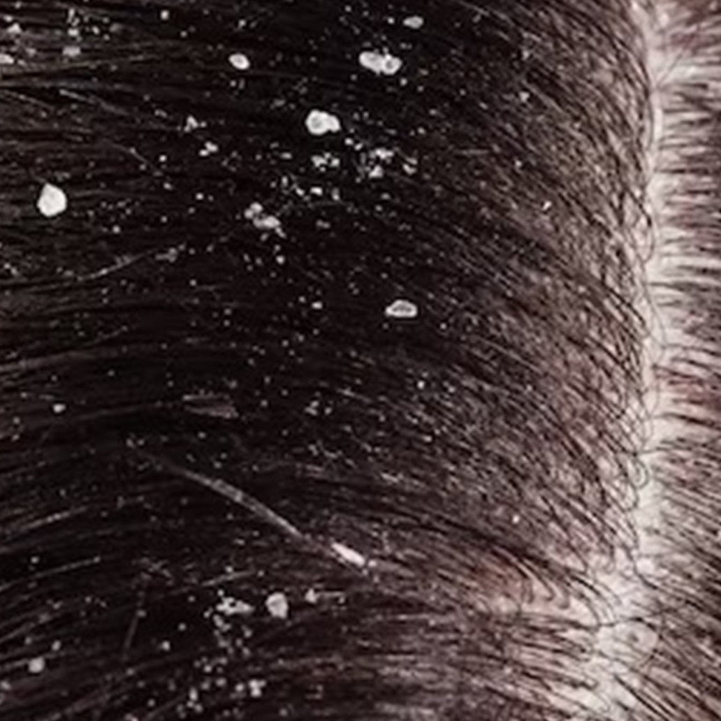 Trik mudah merontokkan ketombe tanpa lidah buaya, ampuh cuma andalkan 1 jenis minuman