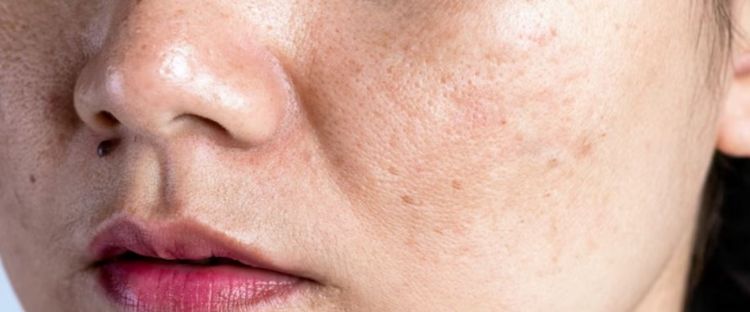 Trik cerahkan flek hitam dan wajah kusam, ampuh cuma andalkan 1 jenis buah-buahan