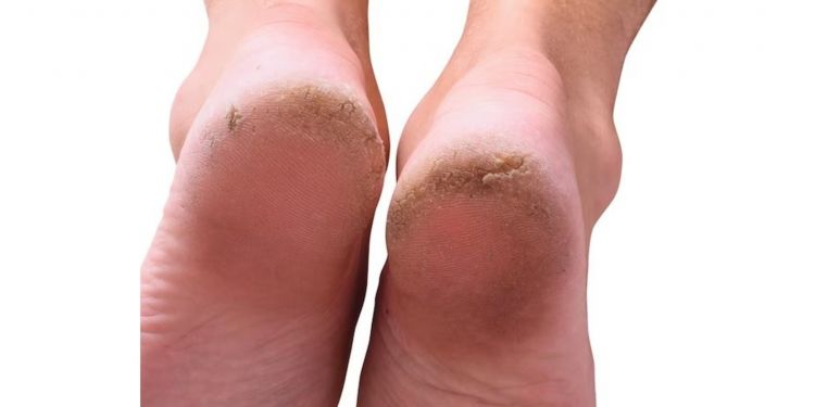 Trik hilangkan tumit kaki pecah-pecah tanpa petroleum jelly, ampuh cuma andalkan 1 jenis lilin