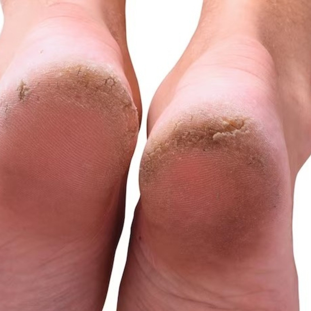 Trik hilangkan tumit kaki pecah-pecah tanpa petroleum jelly, ampuh cuma andalkan 1 jenis lilin