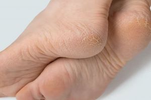 Trik haluskan tumit kaki retak menghitam, hasilnya terlihat dalam satu malam andalkan 2 bahan dapur