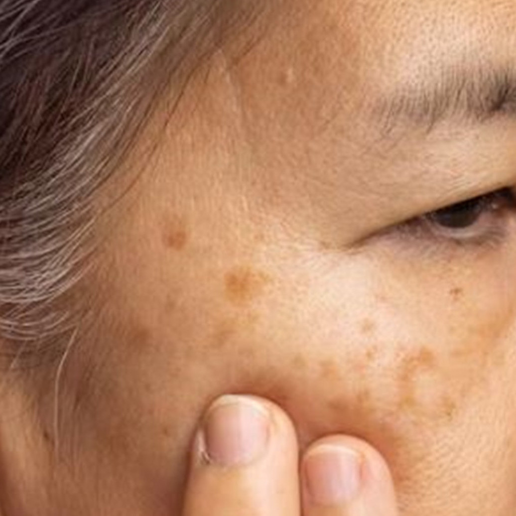 Trik pudarkan flek hitam akibat penggunaan kosmetik, ampuh cuma andalkan 3 bahan alami