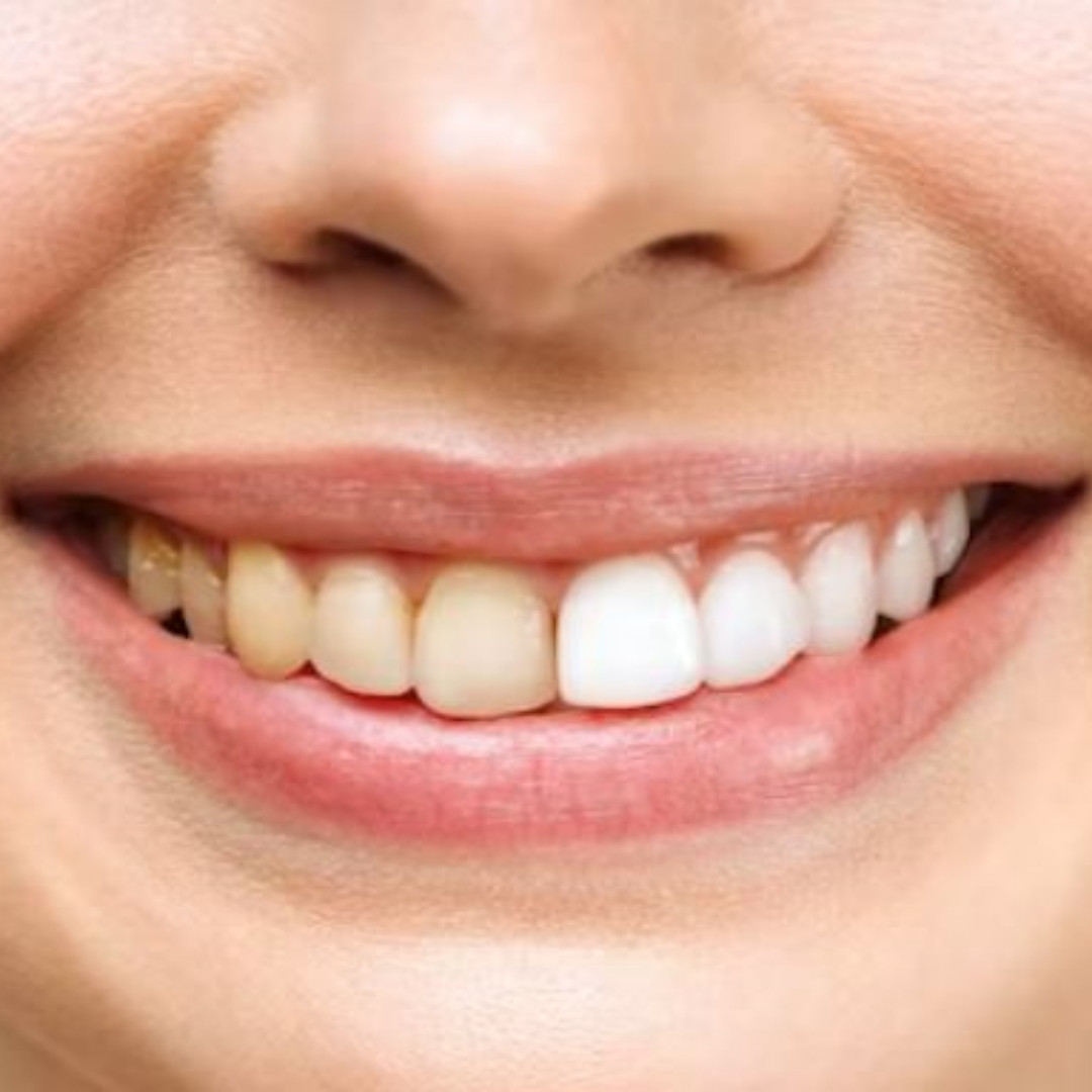 Trik memutihkan gigi penuh plak, ampuh cuma andalkan 2 jenis buah-buahan