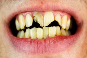 Tanpa bleaching mahal, begini trik atasi gigi kuning pakai pasta gigi dicampur 3 bahan dapur