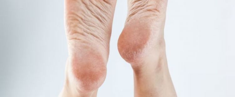 Tak perlu minyak zaitun, begini trik menghaluskan tumit retak dengan satu jenis tanaman herbal