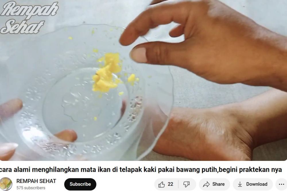 Cara alami menghilangkan mata ikan di telapak kaki ini ampuh cuma pakai 1 bahan dapur